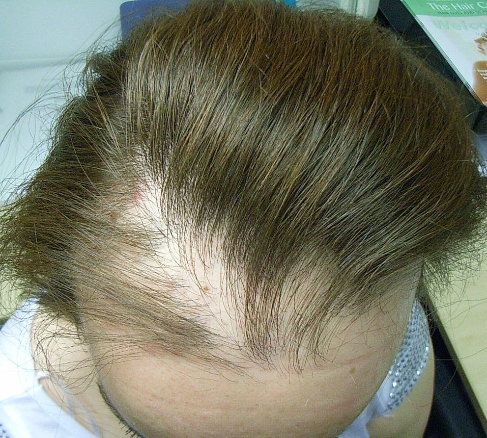 The Hair Loss Centre | More Photos of Female Hair Loss Treated Successfully