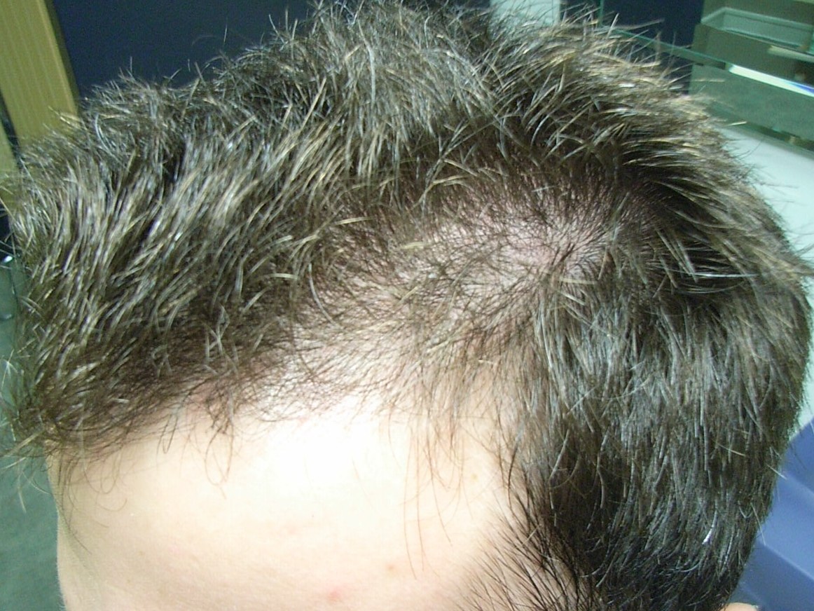 The Hair Loss Centre | Male Hair Loss Treated (Photos) Regrowth on Front  Hairline
