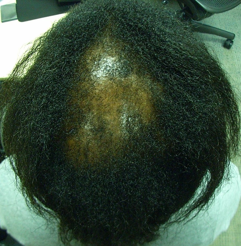 The Hair Loss Centre | Black Hair Loss ( female )BEFORE