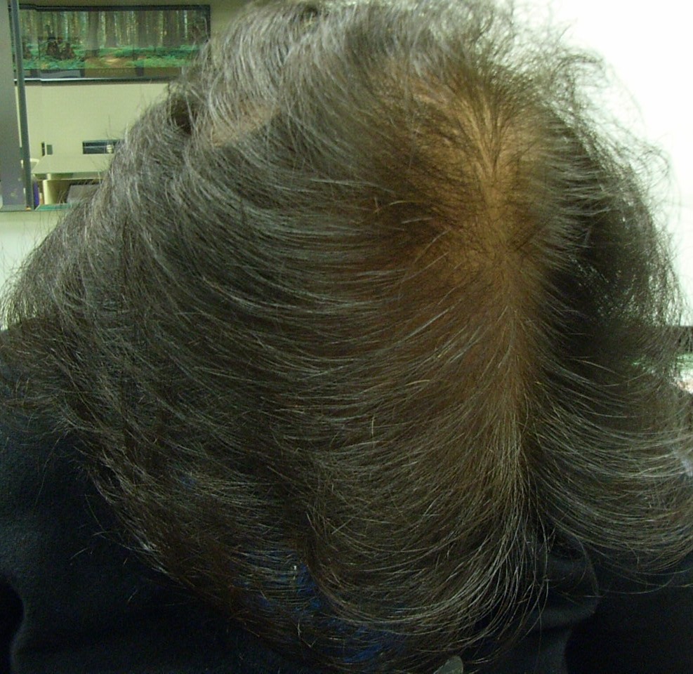 The Hair Loss Centre | Arabian Hair Loss ( female )AFTER