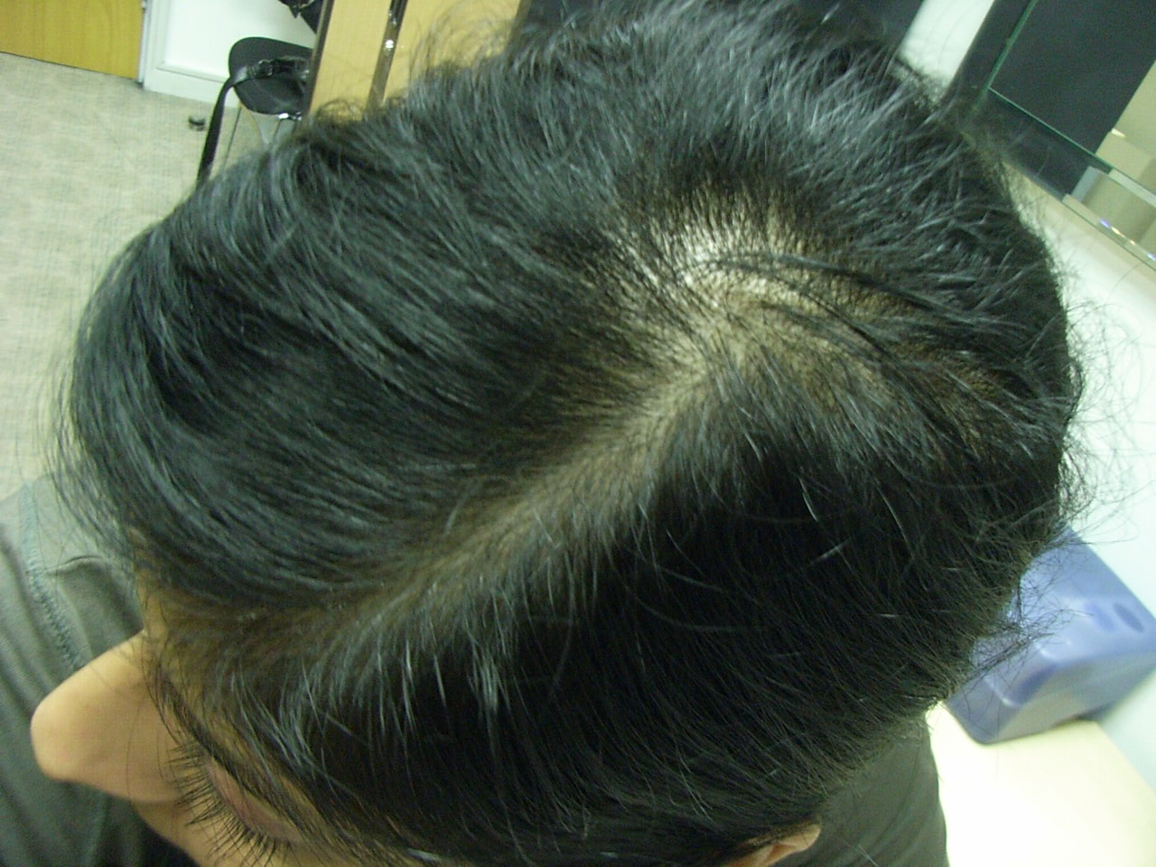 The Hair Loss Centre | Asian Hair Loss ( female )BEFORE