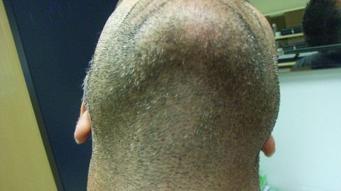 Alopecia Barbae AFTER