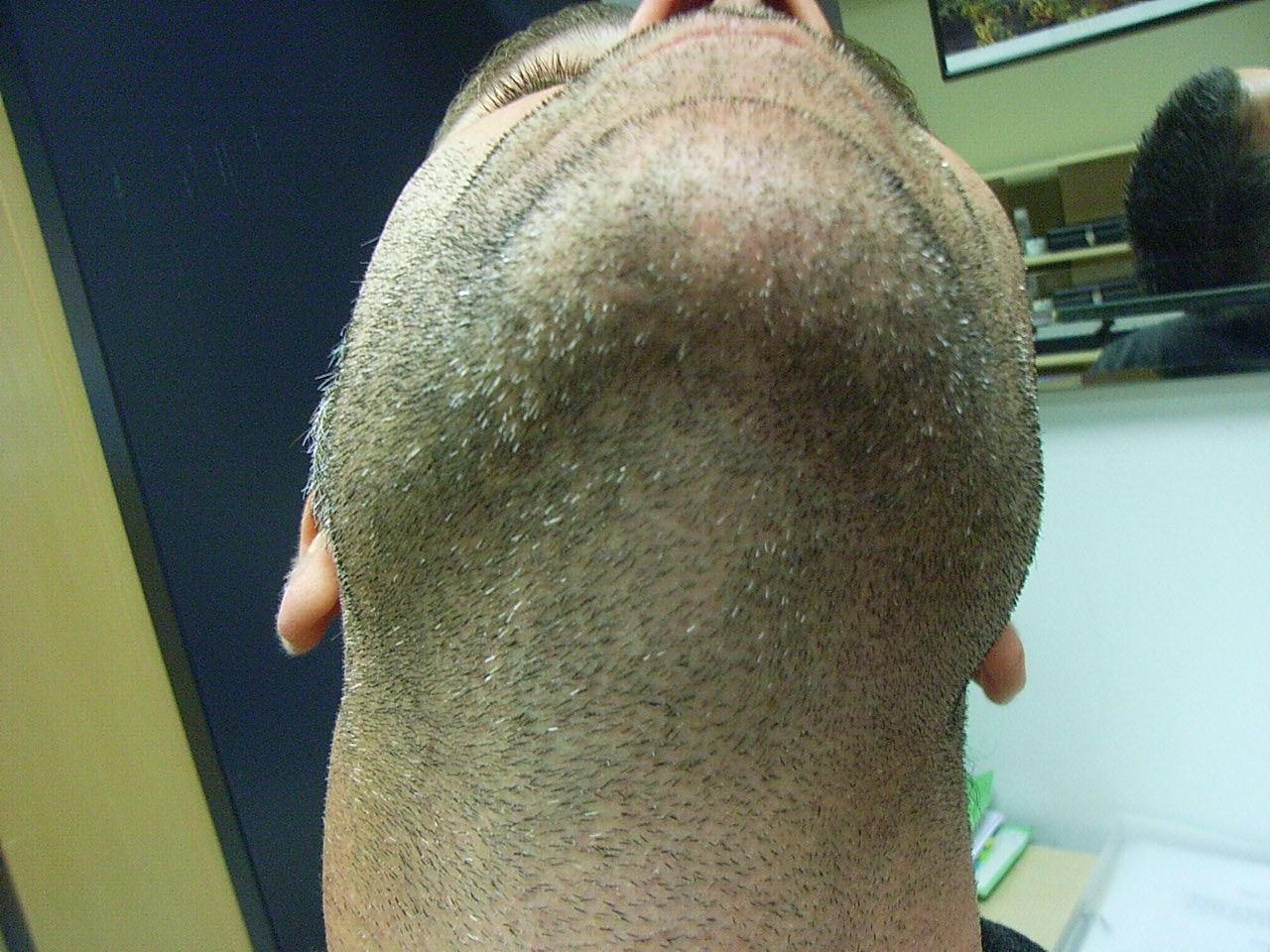 Alopecia Barbae AFTER