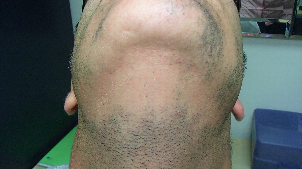 Alopecia Barbae BEFORE