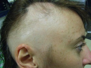 Alopecia Areata- Start Of Treatment