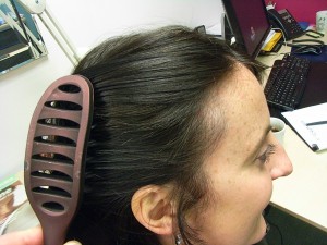 Alopecia Areata- End of Treatment