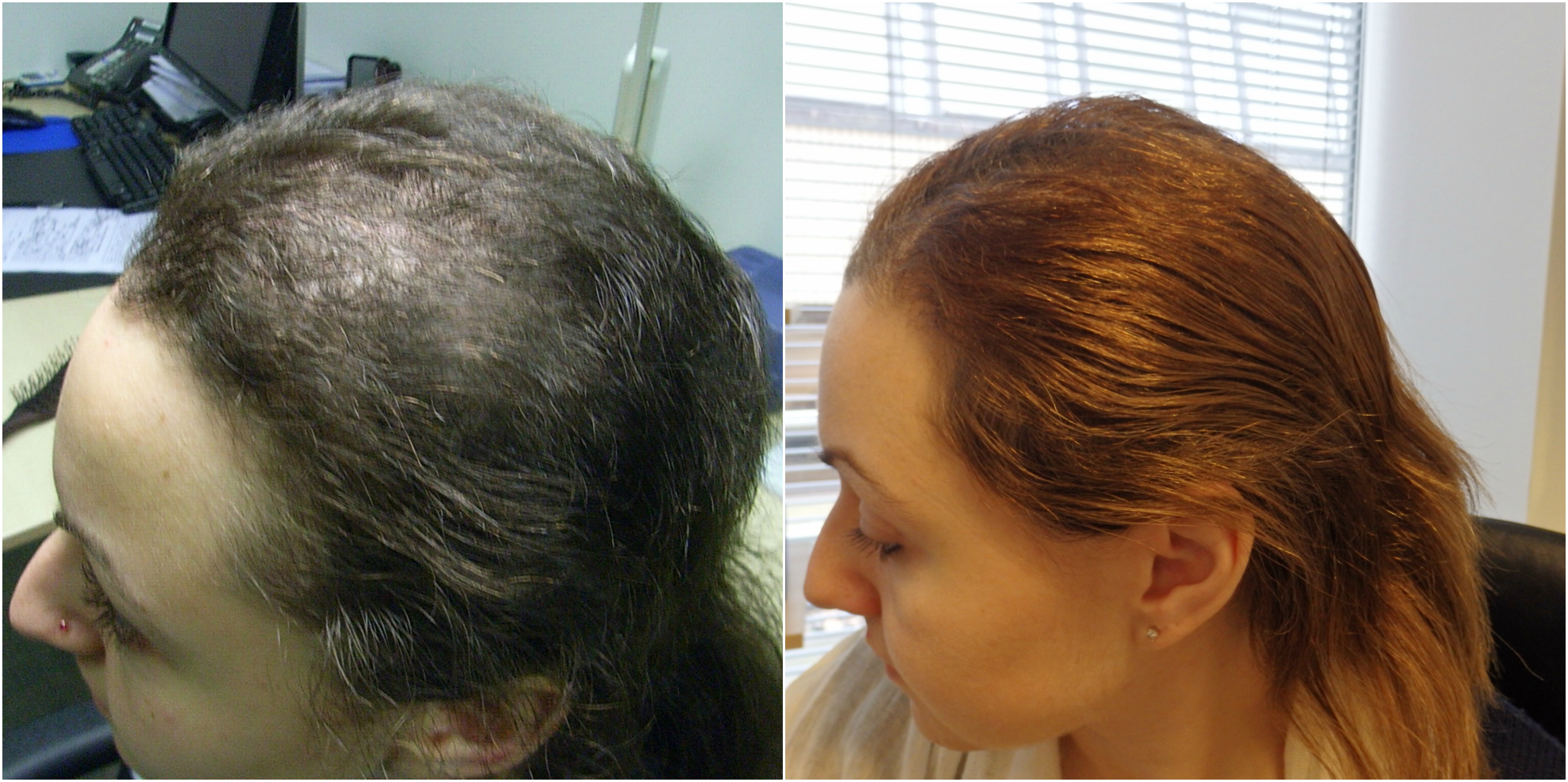The Hair Loss Centre | Trichotillomania Before and after