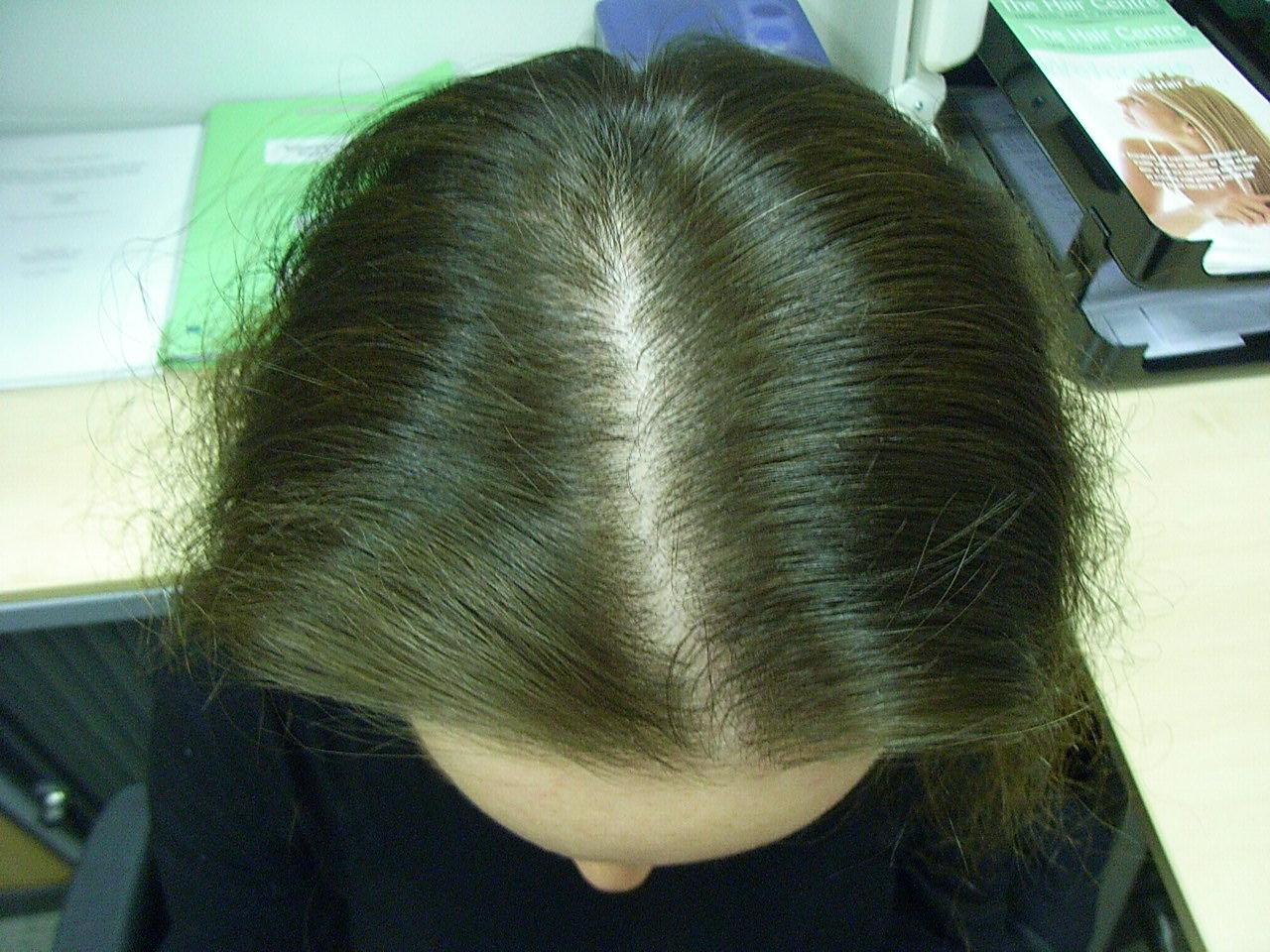 The Hair Loss Centre | Another Success Story: Alopecia Areata Treated