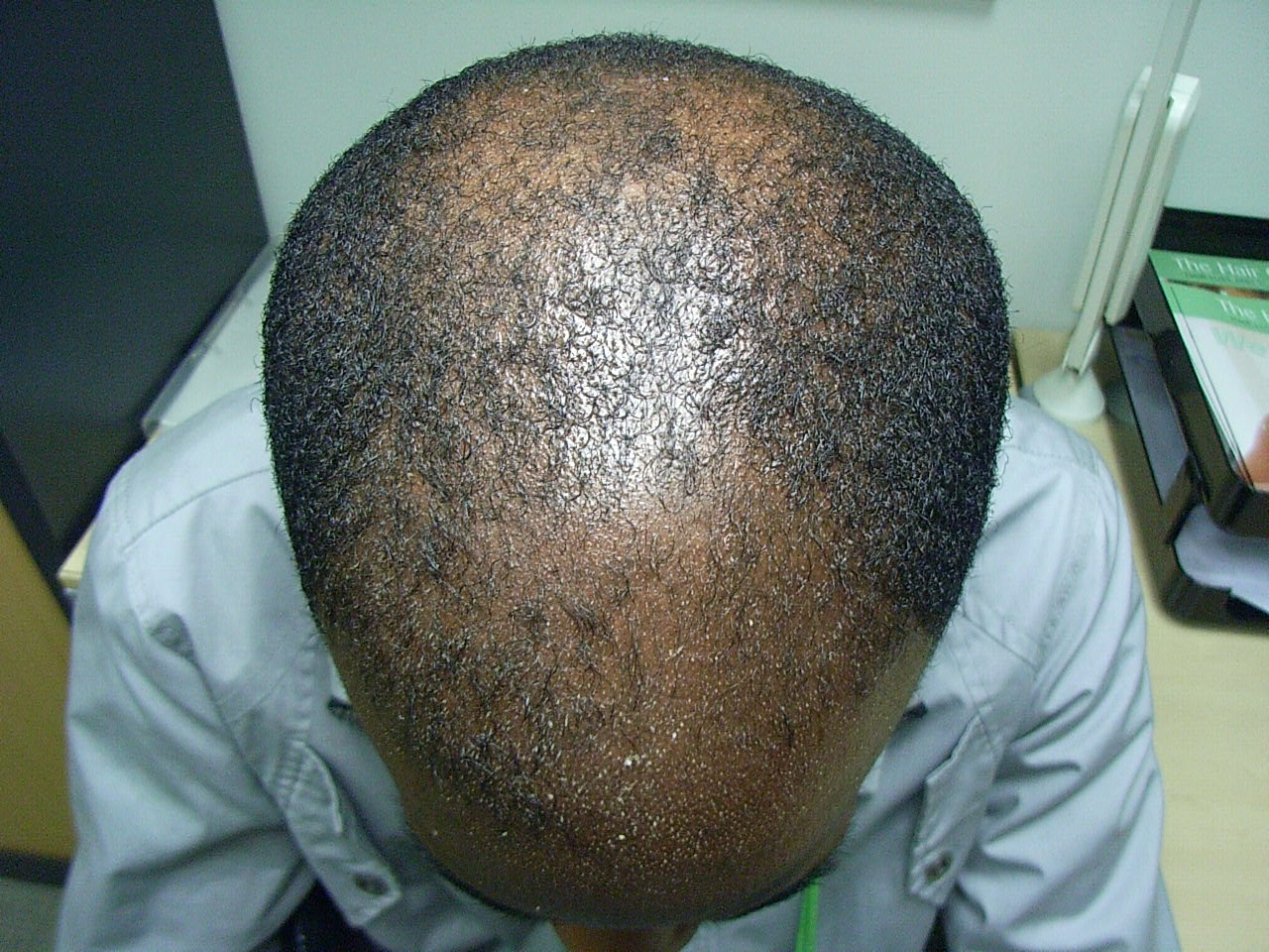 The Hair Loss Centre | Black Hair Loss Treated (Male) Photos